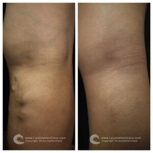 Varicose Vein Transformations of Our Patients - La Jolla Vein & Vascular
