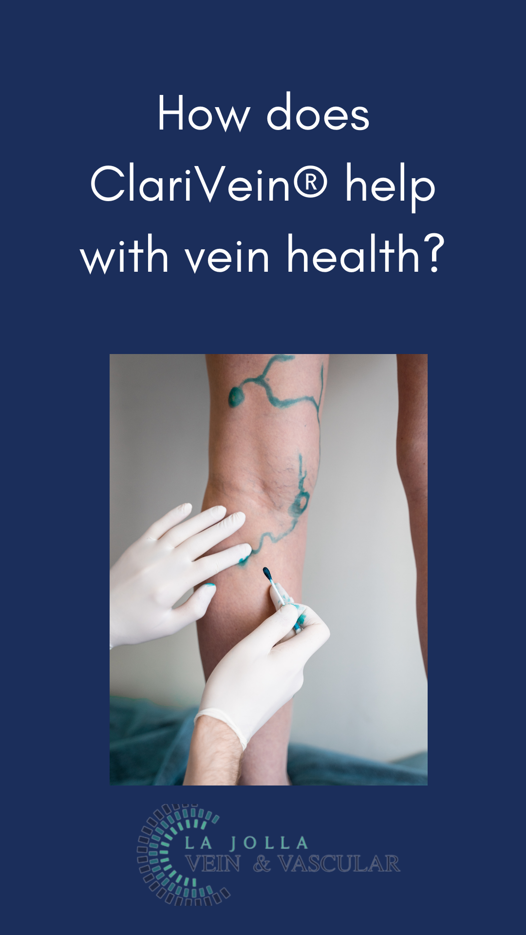 Bunke March Blog Thumbnail-17 ClariVein® Procedure Treatment | Vein & Vascular Care Clinic