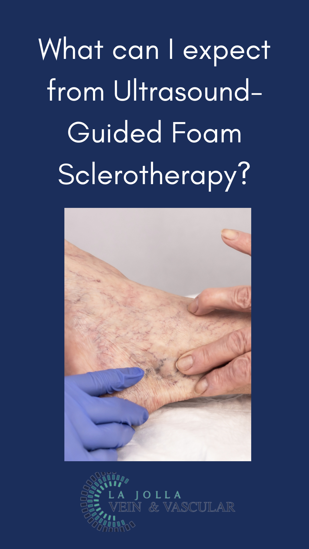 What can I expect from Ultrasound-Guided Foam Sclerotherapy?
