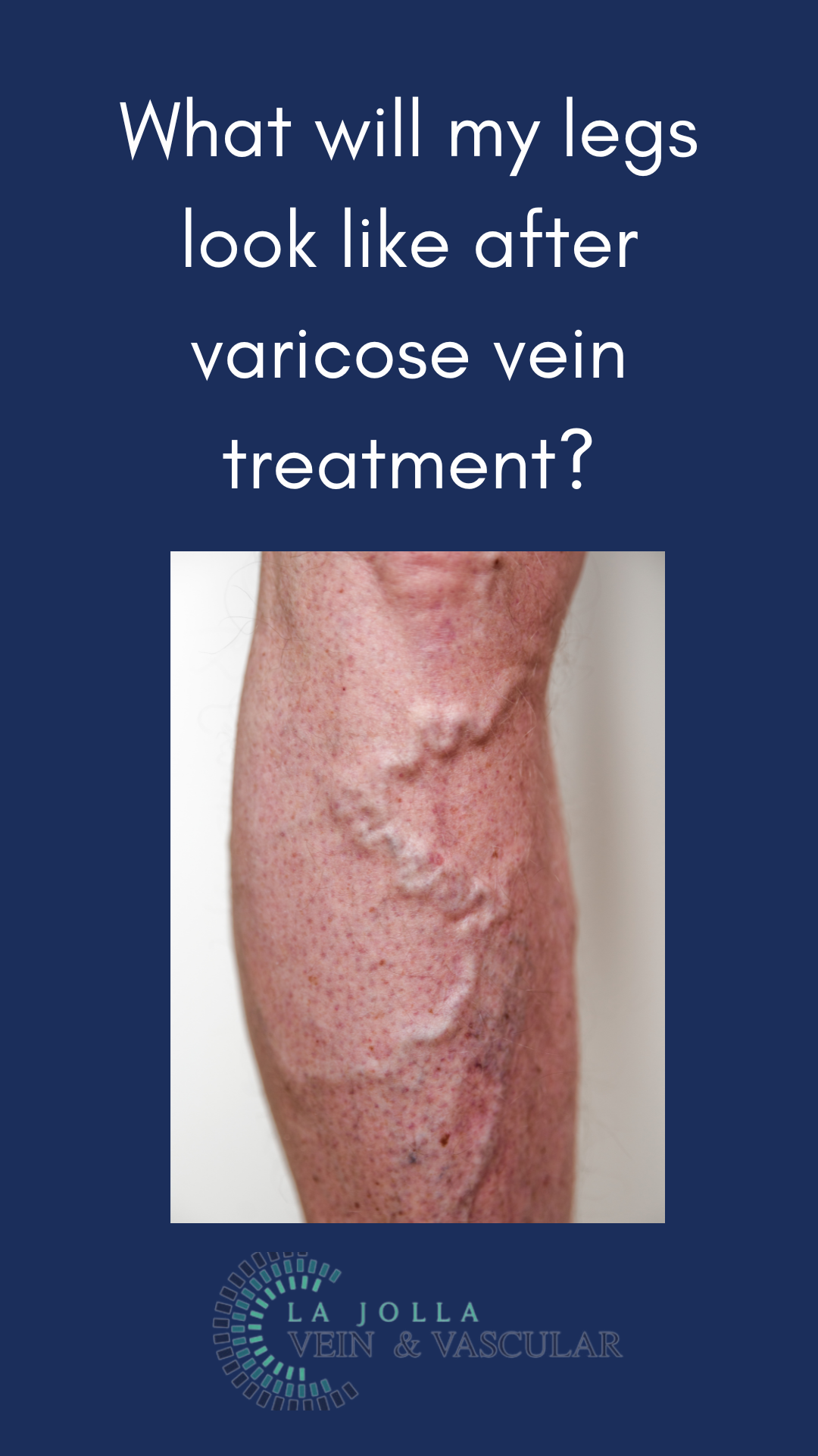 Bunke March Blog Thumbnail-24 What Will Legs Look Like After Varicose Vein Treatment?
