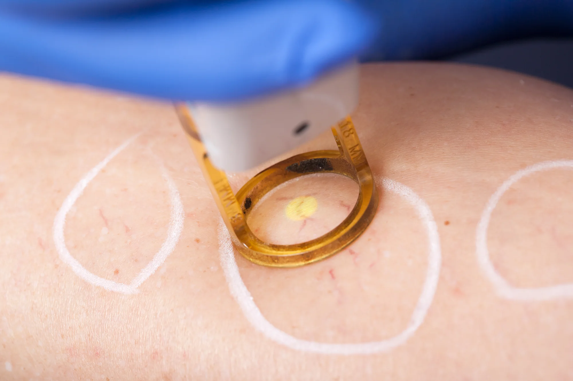 laser for spider veins Laser treating spider veins