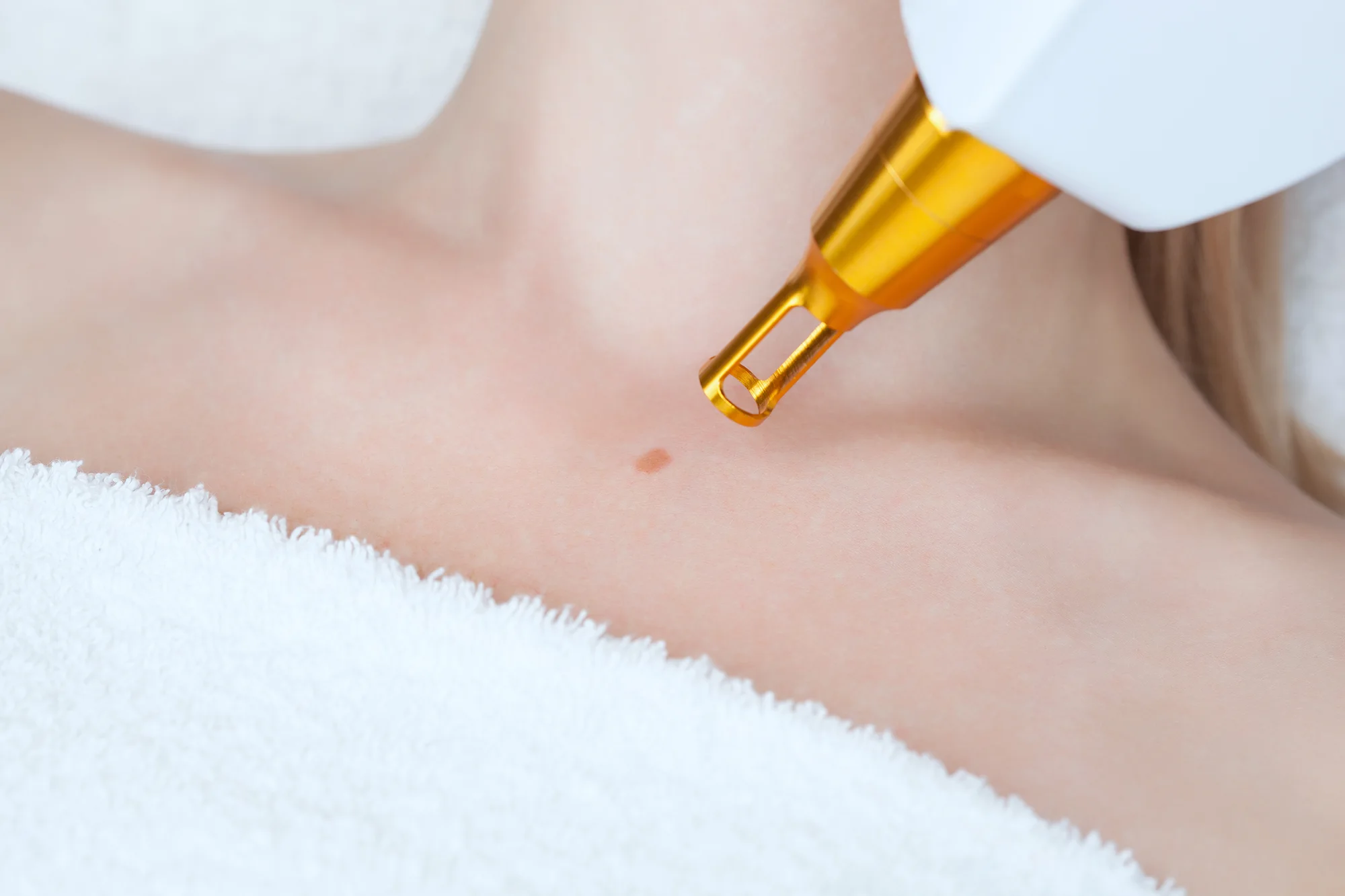 lesion removal by laser laser lesion removal