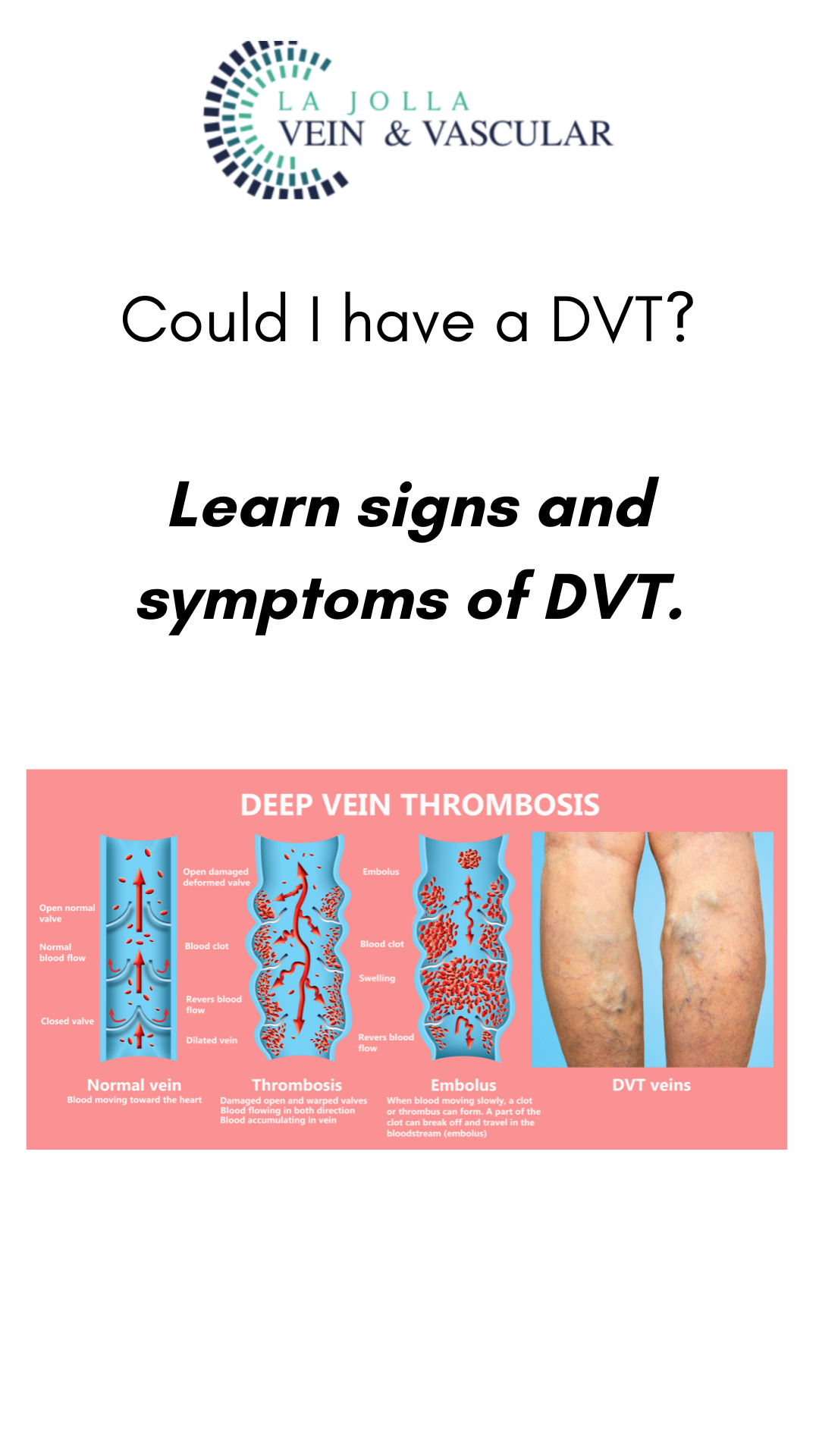 1 Could I Have a DVT? Learn Signs & Symptoms of Deep Vein Thrombosis