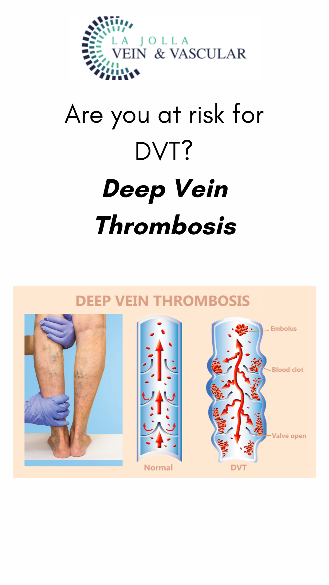 2 Risk for Deep Venous Thrombosis | Learn DVT Risk Factors