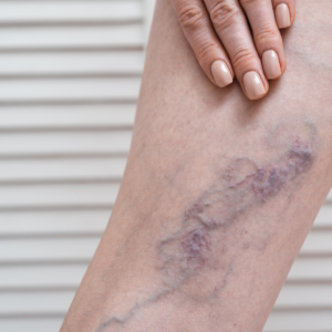 Chronic Venous Insufficiency | Will My Skin Change with Chronic Venous Insufficiency?