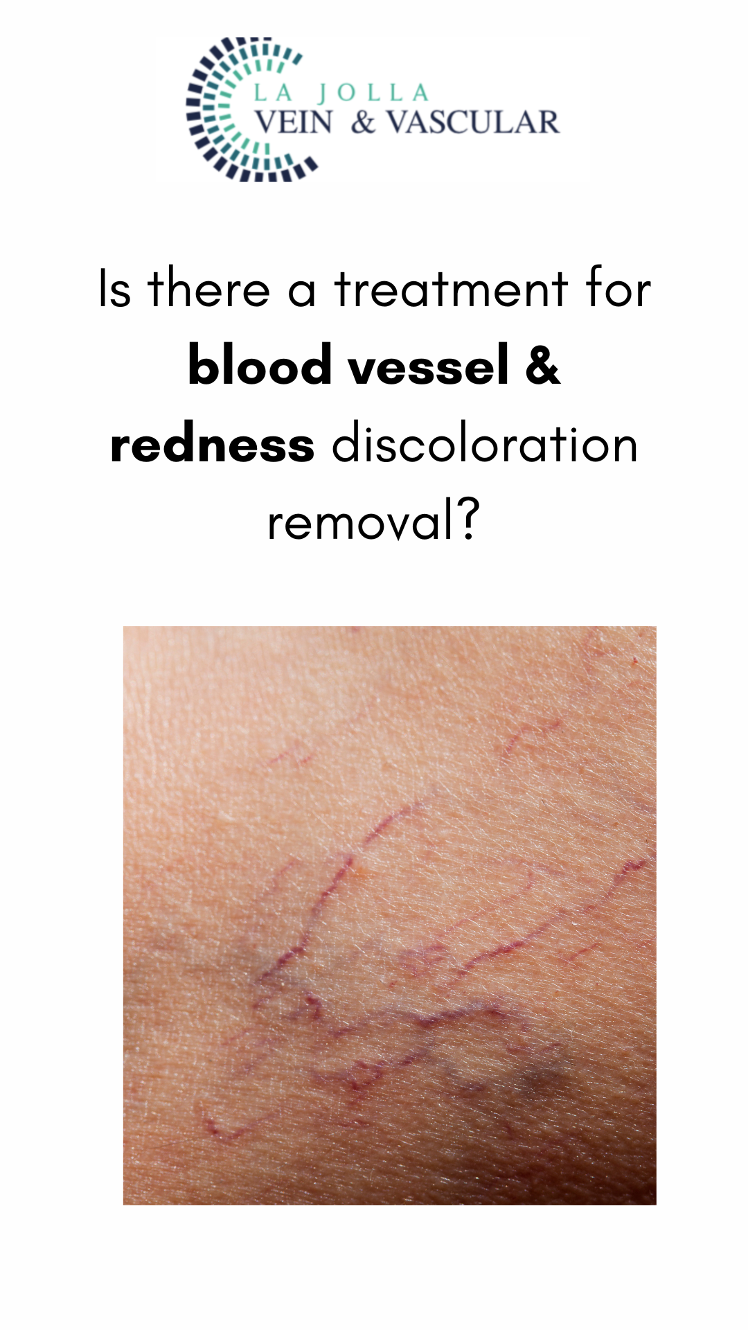 Bunke March Blog Thumbnail-11 Effective and #1 Blood Vessel & Redness Discoloration Treatments