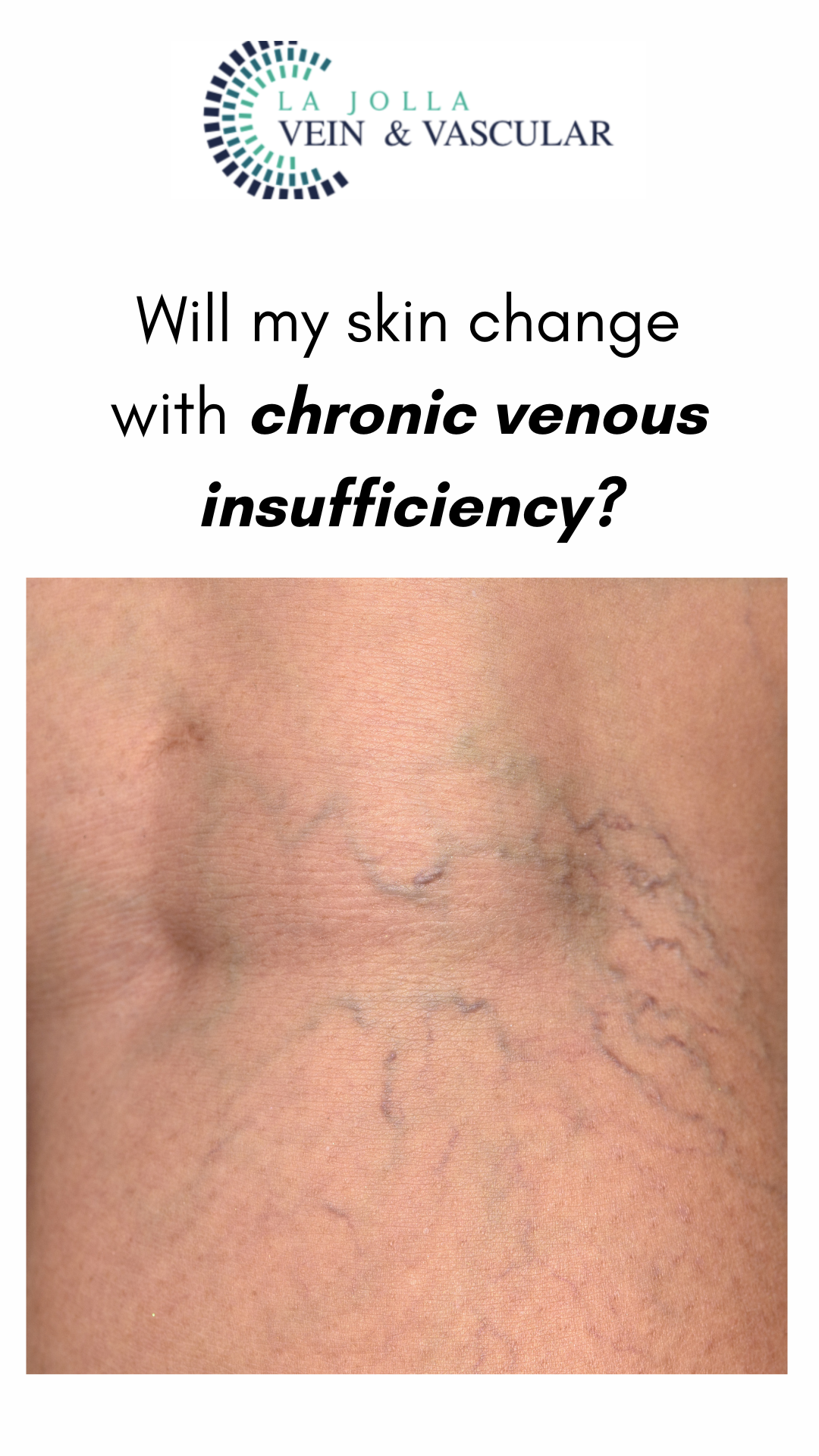 Bunke March Blog Thumbnail-38 Chronic Venous Insufficiency