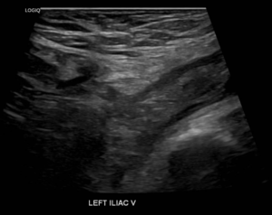 How Do You Diagnose a DVT? Ultrasound Scan Diagnosis
