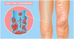 Could I Have a DVT? Learn Signs & Symptoms of Deep Vein Thrombosis