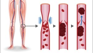 pregnancy | Is Pregnancy a Risk Factor for Deep Vein Thrombosis (DVT)?