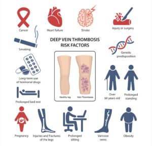 Risk for Deep Venous Thrombosis | Learn DVT Risk Factors