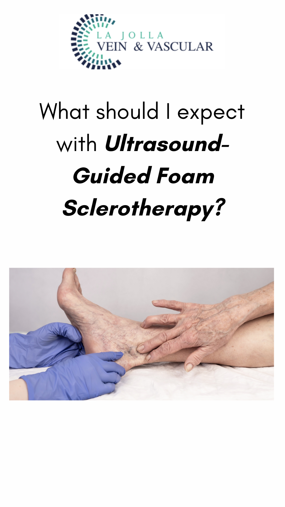sclerotherapy foam