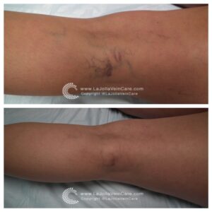 My Legs Feel & Look Like Following Spider Vein Treatment?