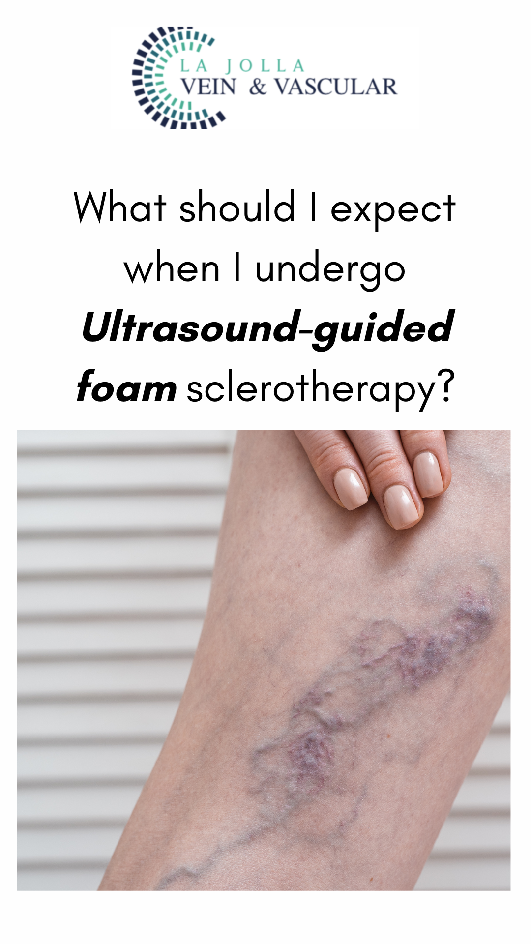 sclerotherapy
