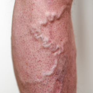 varicose
