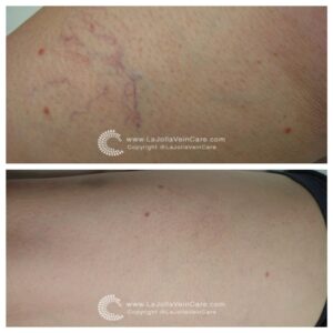 My Legs Feel & Look Like Following Spider Vein Treatment?