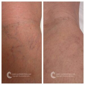 My Legs Feel & Look Like Following Spider Vein Treatment?