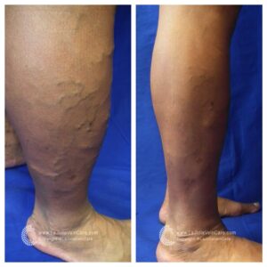varicose vein