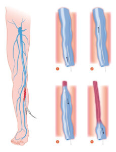 radiofrequency ablation