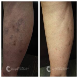 spider | Effective Solutions for Spider Veins: Non-Surgical Treatment