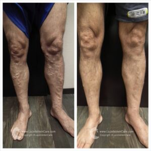 Minimally Invasive | Vein & Vascular Minimally Invasive Treatment | La Jolla