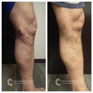 Minimally Invasive | Vein & Vascular Minimally Invasive Treatment | La Jolla