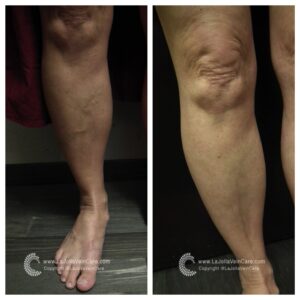Vein & Vascular Minimally Invasive Treatment | La Jolla