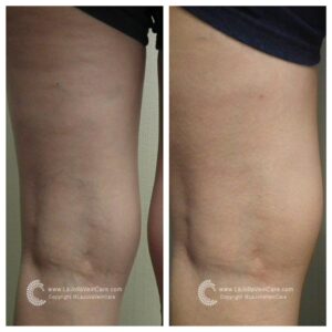spider vein removal