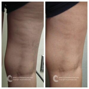 spider vein removal