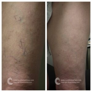 spider vein removal