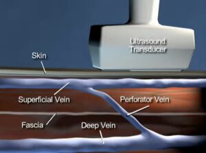 A patient's guide to Radiofrequency perforator ablation procedure 1 Patient’s Guide to Radiofrequency Perforator Ablation