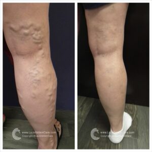 Achieve Healthier Veins Without Surgery | Non-Invasive Treatment
