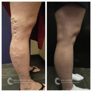Achieve Healthier Veins Without Surgery | Non-Invasive Treatment