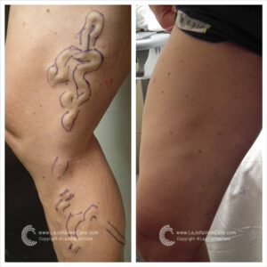 Achieve Healthier Veins Without Surgery | Non-Invasive Treatment