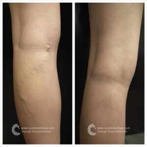 Achieve Healthier Veins Without Surgery | Non-Invasive Treatment