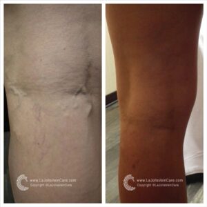 Achieve Healthier Veins Without Surgery | Non-Invasive Treatment
