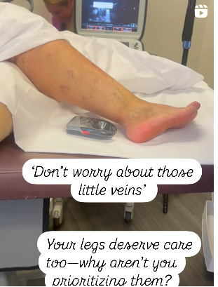 Dont worry about those little Veins